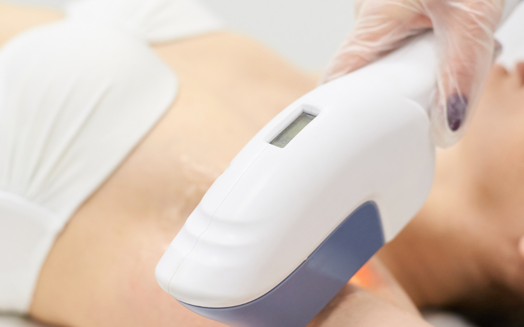 Laser Hair Removal Sale in Surrey: The Benefits of Azure’s ‘Intense Pulse Light’ Service