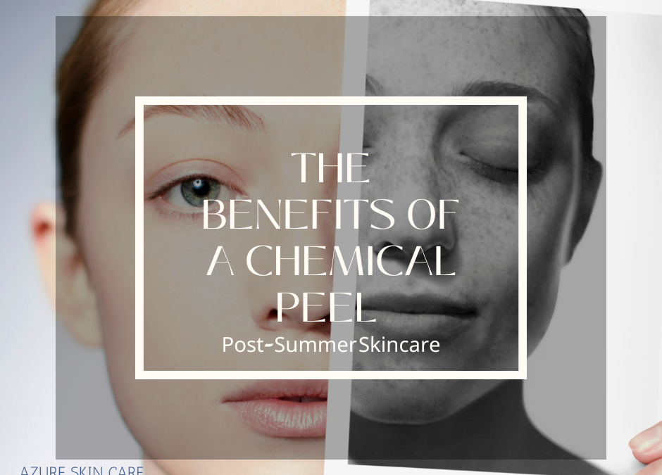 The Benefits of a Chemical Peel